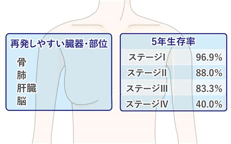 乳がんにおける再発予防｜がん再発予防com