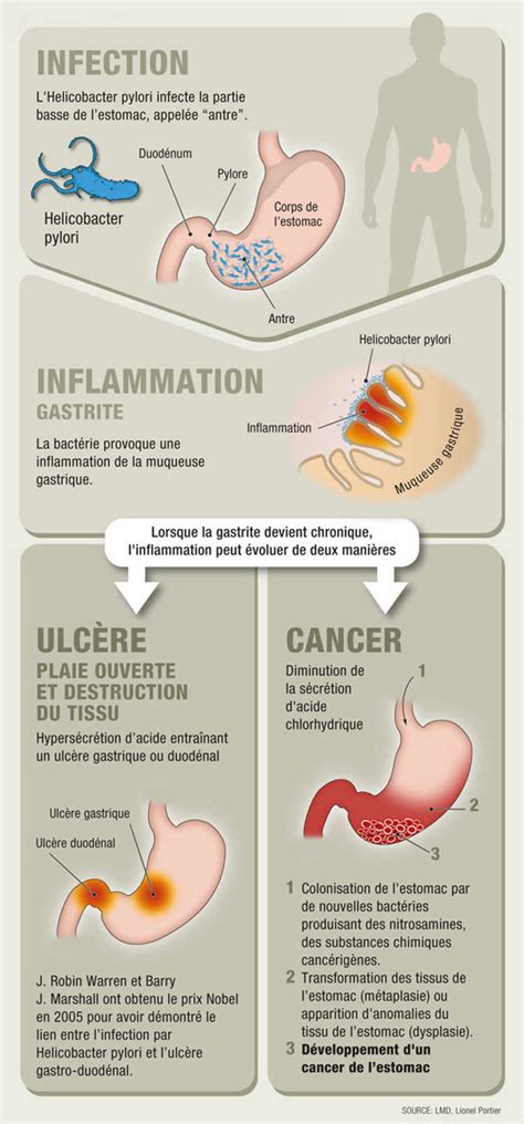 Symptome Cancer De L Estomac Cancer De L Estomac Sympt Mes