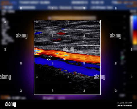 A carotid artery Doppler ultrasound is a diagnostic test used to check ...