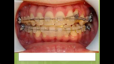 Canine Tooth Double Arch Technique Orthodontist Youtube