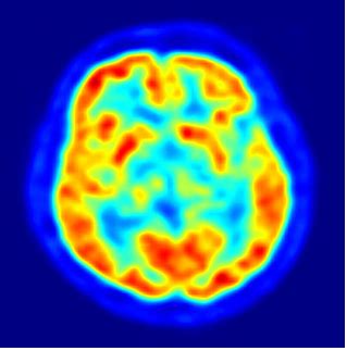 PET scan of human brain. | Download Scientific Diagram