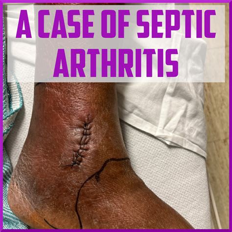 Septic Arthritis And Alcohol At Andrea Johns Blog