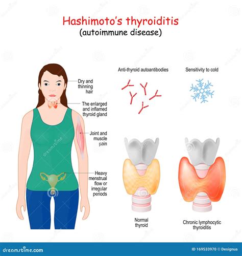 Hashimoto's Thyroid Disease