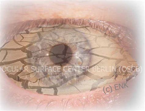 GLIMPSE On Dry Eye Disease Ocular Surface Center Berlin