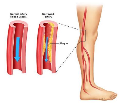 Suffering From Peripheral Arterial Disease Interventional Radiology