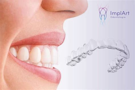 Invisalign Alinhador Transparente Kb Implante Dent Rio E Pr Tese