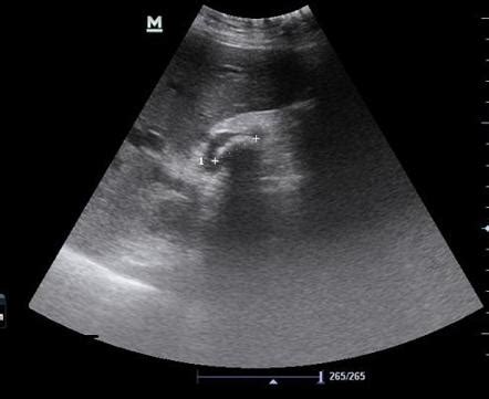 Bile duct stone | Radiology Case | Radiopaedia.org