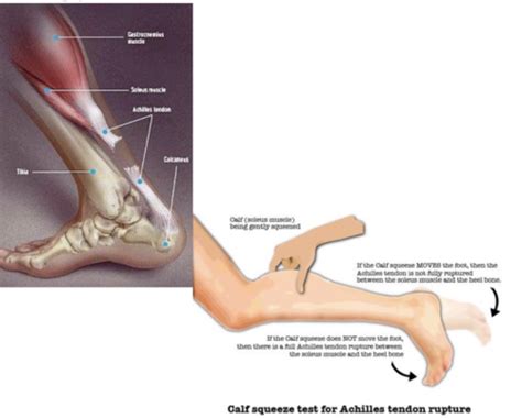 Msk Ankle Foot Flashcards Quizlet