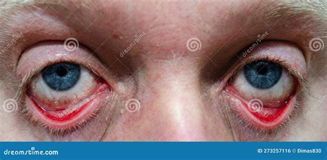 Red Swollen Eyelids And Eyeballs In An Adult Male Close Up Stock Photo