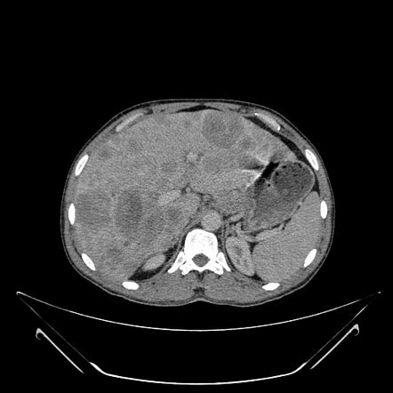 Hepatic Metastases From Gastric Cancer Image Radiopaedia Org