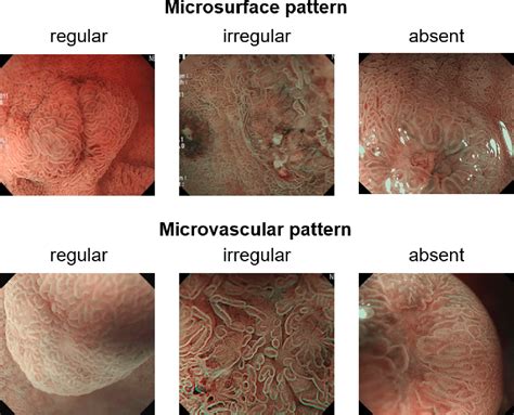 Figure 1 From Magnifying Endoscopy With Narrow Band Imaging For