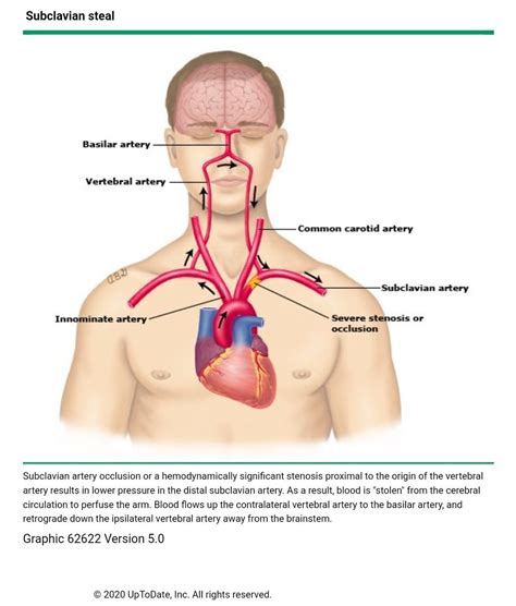 Subclavian Artery Vertebral Artery