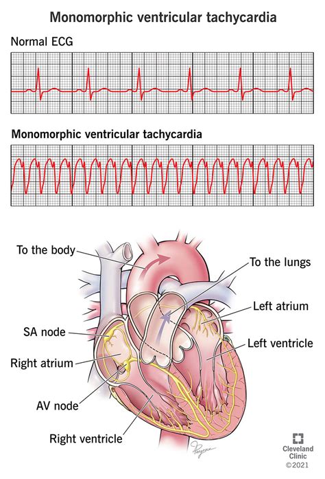 Ventricular Tachycardia Ecg