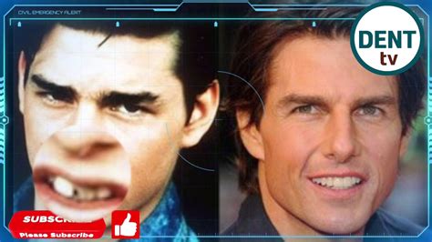 Tom Cruise Teeth Before And After Braces - 33 Before And After Photos ...