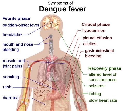 File:Dengue fever symptoms.svg - Simple English Wikipedia, the free ...