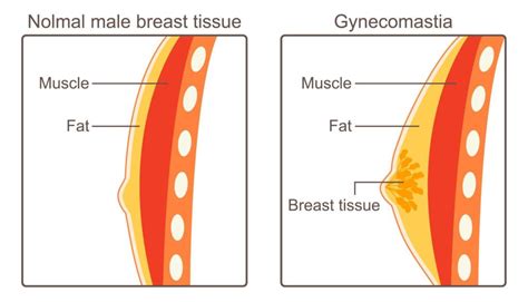 Medfina Complete Look At The Types Of Gynecomastia Tissue Medfin