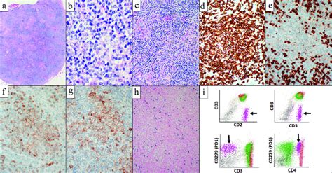 Level 4 Lymph Nodes Biopsy And Corresponding Flow Cytometric Analysis Download Scientific