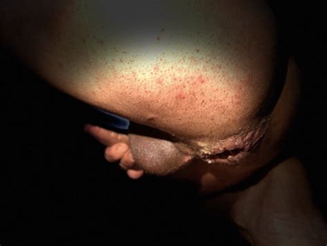 Dilatation Anal 7 Pics XHamster