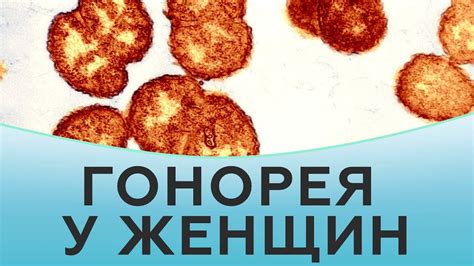 Гонорея у женщин. Лечение гонореи - YouTube