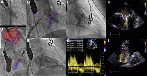 Procedural Guidance Computed Tomography Fluoroscopic Landmark Fusion