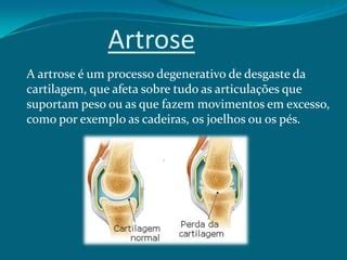 Patologia Estudada Artrite E Artrose Ppt