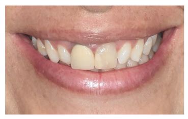 Sorriso Renovado Fluorescer Cl Nica Odontol Gica