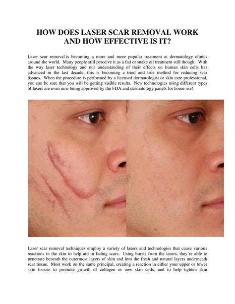 GIT Expert - HOW DOES LASER SCAR REMOVAL WORK AND HOW EFFECTIVE IS IT ...