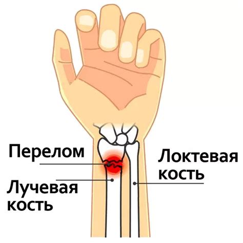 Реабилитация после перелома кости руки - Физиоцентр