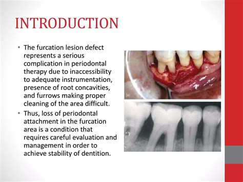 Furcation Involvement Ppt