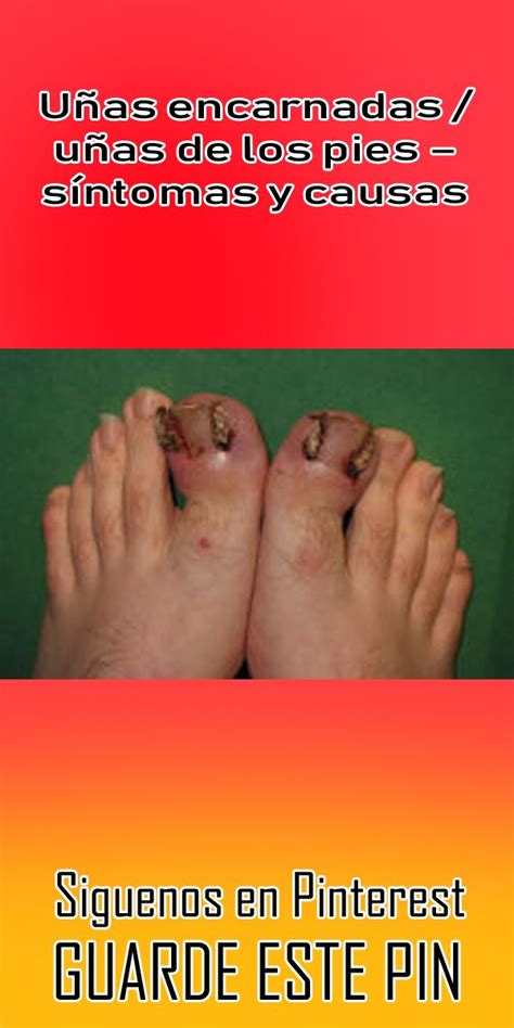 Uñas encarnadas uñas de los pies síntomas y causas uñas pies Beauty