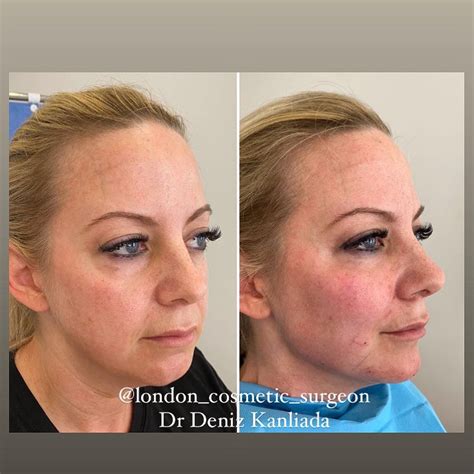 Micro Fat And Nano Fat Transfer For Face Rejuvenation Dr Deniz Kanliada