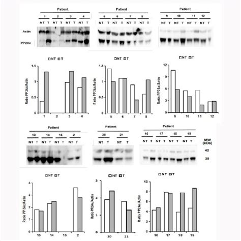 Western Blot Analysis Of Pp2a Expression In 21 Patient Samples For Of