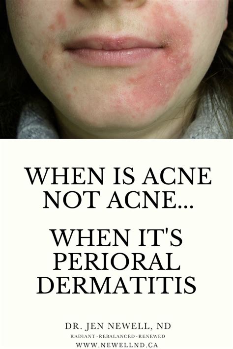 Perioral Dermatitis Artofit