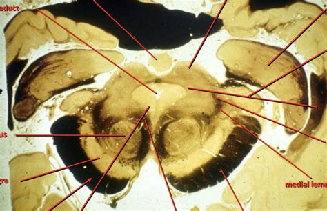 ANAT 2160 Rostral Midbrain At Level Of Superior Colliuclus Diagram