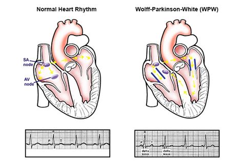 Wolff-Parkinson-White Syndrome (WPW): Symptoms, Causes