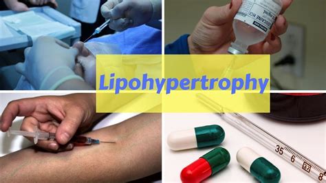 What is lipohypertrophy | Medical tests, Health tips, Medical