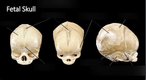 Fetal Skull Diagram | Quizlet