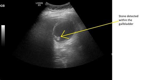 Diseased Gallbladder Ultrasound