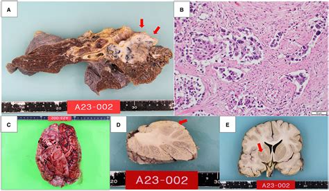 Frontiers Case Report An Autopsy Report Of Patient With Metastatic