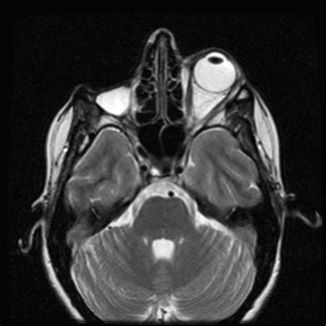 Enucleation Image