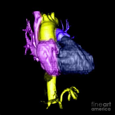 Color Enhanced 3d Cta Of Heart Photograph By Medical Body Scans Pixels