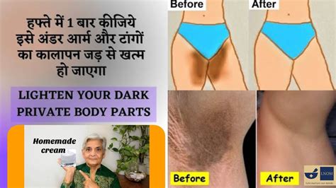 Lighten Your Dark Armpits And Inner Thighs In Less Then Uses Youtube