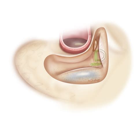 Anatomical Variation in Mastoidectomy – Oto Surgery Atlas