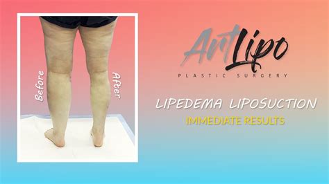 Lipedema Leg Liposuction Surgery Cankles Knees Immediate Results