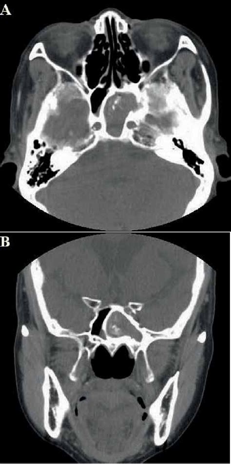 Figure 1 From A Retrospective Analysis Of 29 Isolated Sphenoid Fungus Ball Cases From A Medical