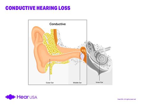 Conductive Hearing Loss - The Complete Guide [2024]