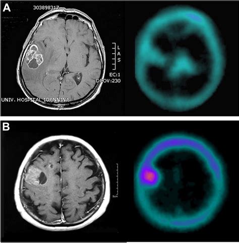 Cellular And Molecular Imaging With SPECT And PET In Brain Tumors