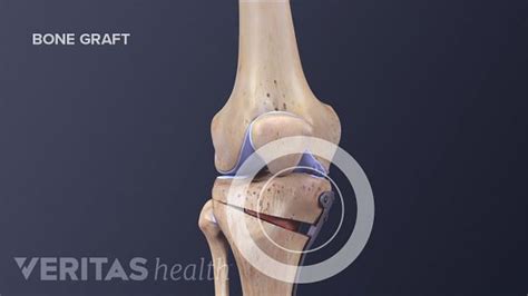 Knee Osteotomy Surgery