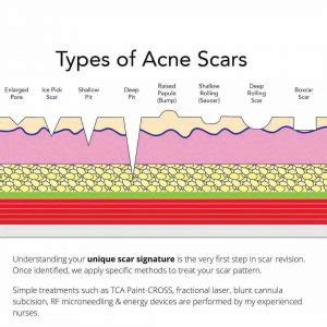 Microdermabrasion For Acne Scars - Dr Davin Lim