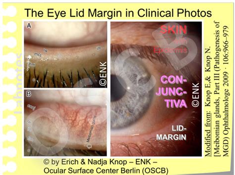 Meibomian Gland Diagram